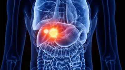 طريقة واعدة لعلاج سرطان الكبد