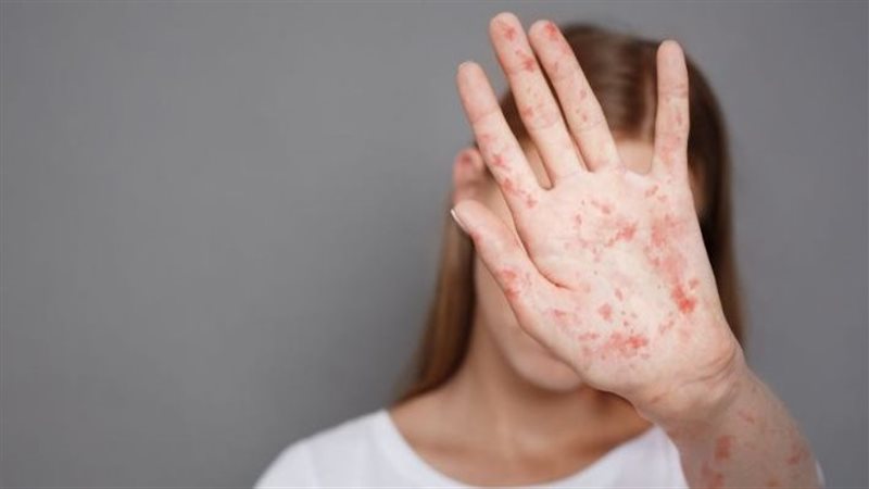 الحصبة الألمانية