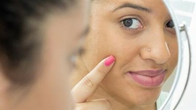 بالأعشاب.. 6 طرق لعلاج تصبغات الوجه للفتيات