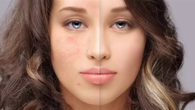 أضرار السكر مع بشرة الفتيات 