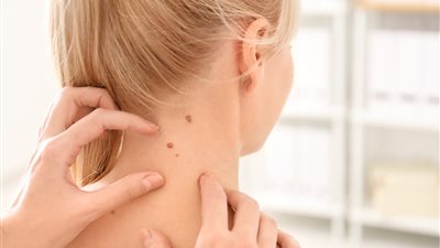 5 طرق للتخلص من الزوائد الجلدية بالمنزل.. تعرفي عليها