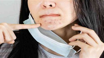 حبوب الوجه بسبب الكمامة.. ازاي تعالجيها