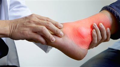 داء الملوك.. تعرفي على أعراضه وطرق العلاج 