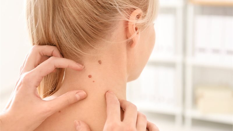 الزوائد الجلدية 