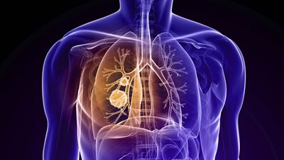 أسباب الإصابة بمرض الانسداد الرئوي المزمن وطرق علاجه