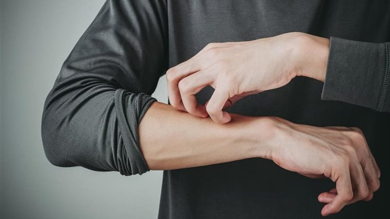 مرض الصدفية