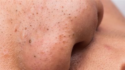 3 ماسكات طبيعية تخلصك من الرءوس السوداء فى المنزل