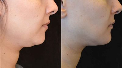 10 نصائح للتخلص من دهون الرقبة بشكل طبيعي