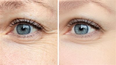 بدون مستحضرات طبية.. 6 طرق طبيعية للتخلص من 