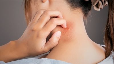 14 علاجا منزليا بسيطا للعدوى الفطرية