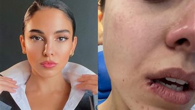 سلمى أبو ضيف تكشف عن معانتها الصحية بسبب الليزر (صور)