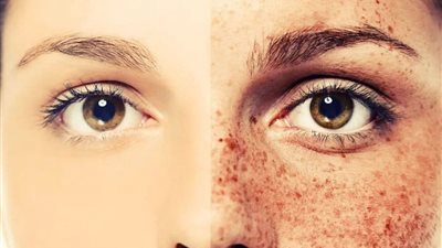 ظهور بقع بنية على وجه الفتاة.. أشهر الأمراض الجلدية في الصيف| فيديو