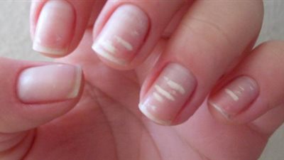 «بقع الأظافر البيضاء».. تعرفي على أسباب الإصابة 