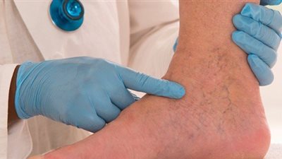 أبرزها «سعال الدم».. أعراض جلطة الساق عند الحامل 