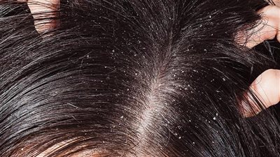 بـ «خل التفاح وماء البصل».. وصفات سريعة للقضاء على قشرة الشعر