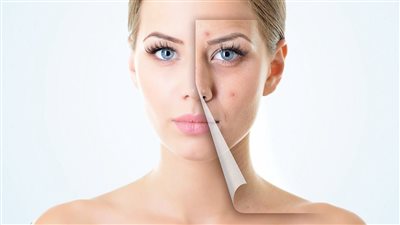 احصلي على بشرة صافية من الحبوب عن طريق 5 أطعمة 