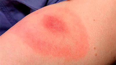 ابعدي عن المضاد الحيوي.. طبيبة تكشف مفاجآت عن حساسية الصدر | فيديو 