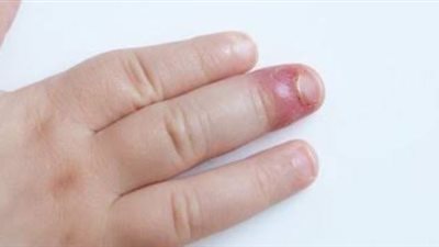 الأعراض وطرق العلاج.. أسباب ظهور صديد تحت الظفر