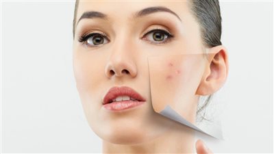 أهمها «السكريات».. 3 أطعمة تسبب حَبّ الشباب