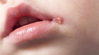 الدكتور هاني الناظر يُحذر الأمهات من فيروس الهربس