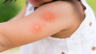 لو عندك حساسية من قرص الناموس والحشرات.. 3 طرق للعلاج