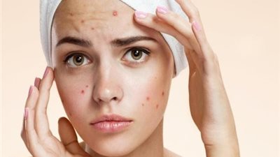 خبيرة تجميل تكشف طريقة استخدام الصابون المغربي لإخفاء حبوب الوجه