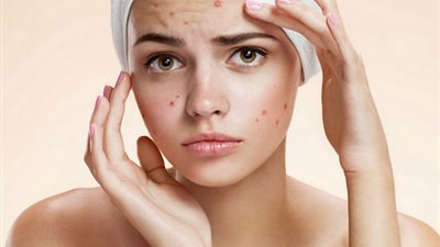 أبرزها الشاي الأخضر.. عالجي حب الشباب بـ 3 مشروبات طبيعية 