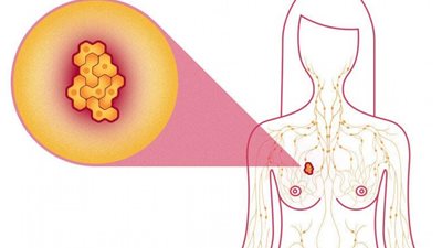 8 أعراض تكشف الإصابة بـسرطان الثدي عند المرأة 