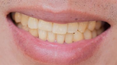 احذري.. 5 مشروبات تحول أسنانك إلى اللون الأصفر!