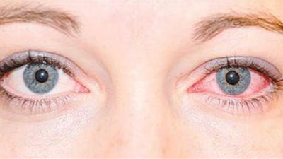 وصفات طبيعية منزلية لعلاج 