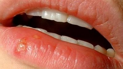 أسباب بثور الشفاه وطرق علاجها