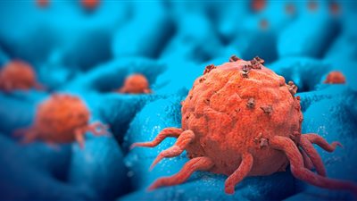 رئيس وحدة الأورام بجامعة المنصورة يكشف لـ«هير نيوز» أبرز أسباب الإصابة بالسرطان