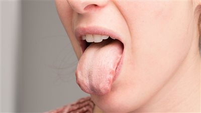 طرق طبيعية لعلاج «قرحة اللسان»