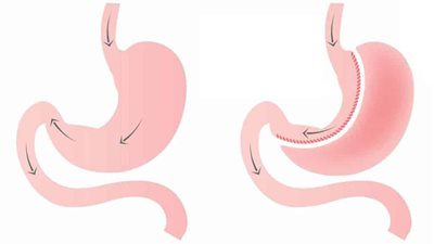 طبيب يحذر من السمنة المفرطة ويكشف السن المناسبة لتكميم المعدة