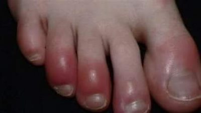 أفضل طريقة لعلاج تورم أصابع اليد والقدم في الشتاء