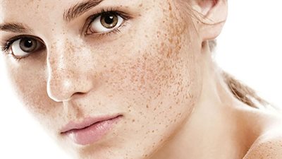 7 وصفات طبيعية لإزالة نمش الوجه نهائيًا