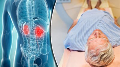 دراسة: دواء سرطان الكلى يُعالج النوبات القلبية بنسبة 75 %