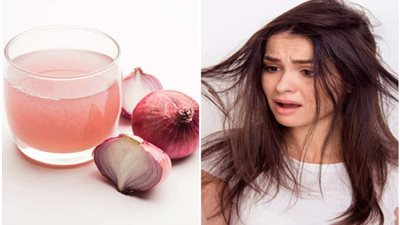 خبراء: فرك البصل على الرأس يحمي من الإصابة بالصلع