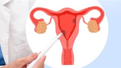 بطانة الرحم المهاجرة.. اعرفي الأعراض وطريقة العلاج 