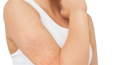ما سبب الإصابة ببشرة «جلد الدجاج» وكيف تتخلصين منها؟
