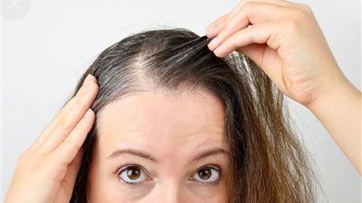 «هرموني ولا وراثي».. أنواع وأسباب صلع السيدات وعلاجه