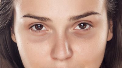 هل يعالج فيتامين «هـ» الهالات السوداء تحت العين؟ دراسة أمريكية تجيب