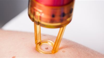 الفيروس الحليمي البشري.. احذري من عدوى فيروس hpv مع إزالة الشعر بالليزر