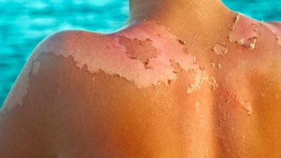 وصفات طبيعية لتخفيف حروق الشمس.. زيت جوز الهند ودقيق الشوفان