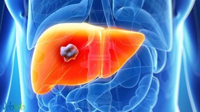 احذري.. أعراض تدل على إصابتك بمرض الكبد الدهني