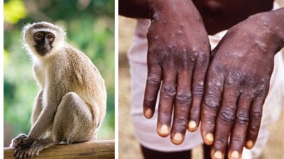 جدري القرود.. الصحة تُعلن عن حقائق تُنشر لأول مرة