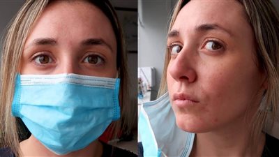 طرق فعالة لمنع ظهور حب الشباب عند ارتداء الكمامة