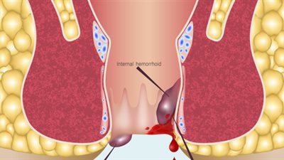 نصائح ذهبية للوقاية من البواسير.. وطرق علاجها 