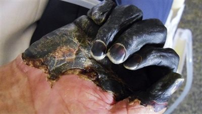 «الموت الأسود».. طبيب يشرح الأعراض ونسبة الخطورة من انتشار الطاعون الدبلي