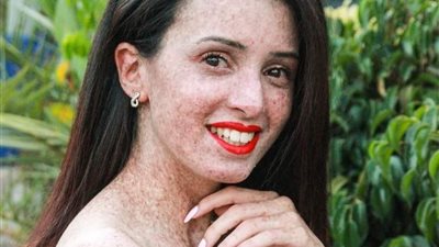 «13% من أطفال العالم».. أطفال القمر مرض وراثي نادر له ثمانية أنواع